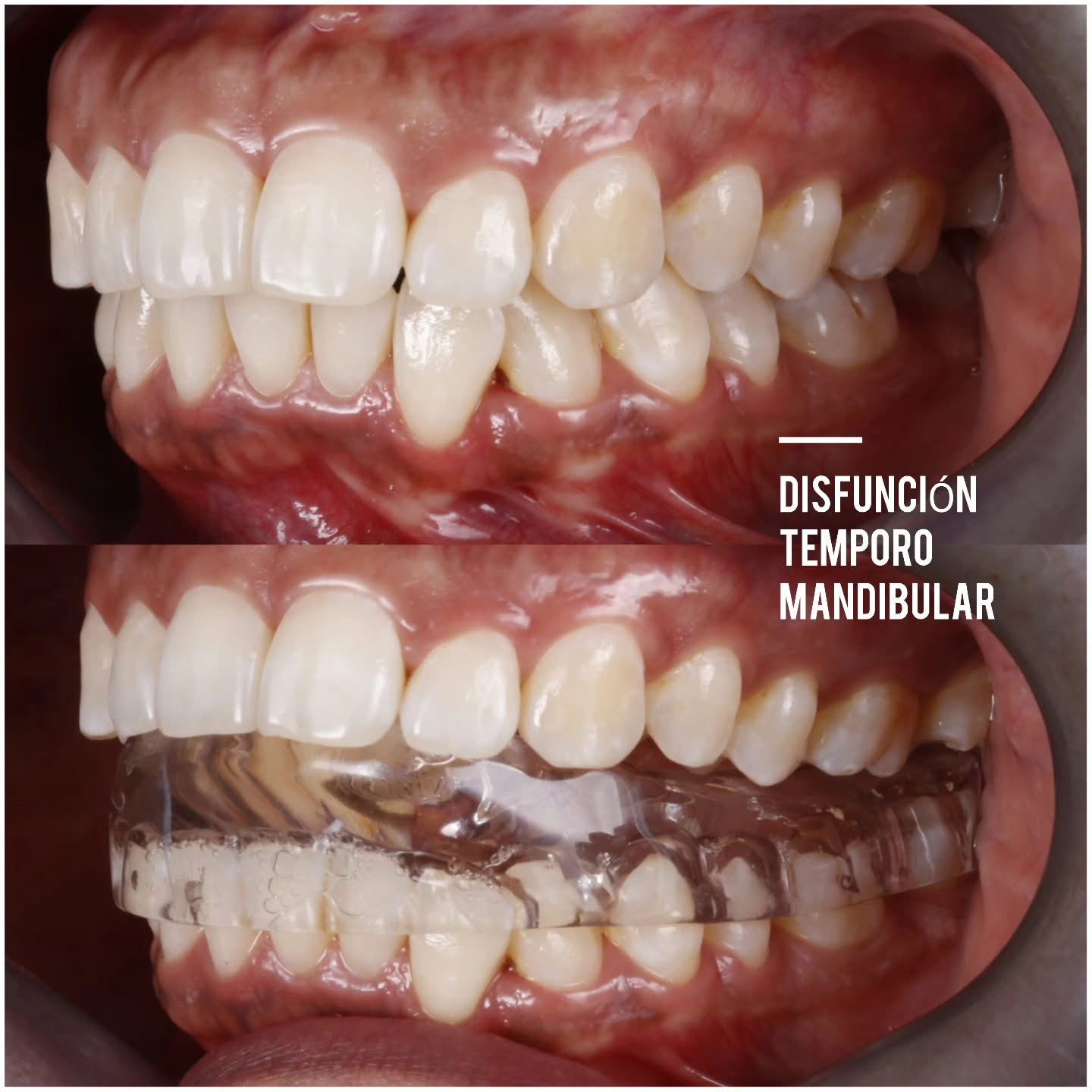 Guarda Gnatológica (Férula de Descarga)